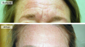 botox-filler-1